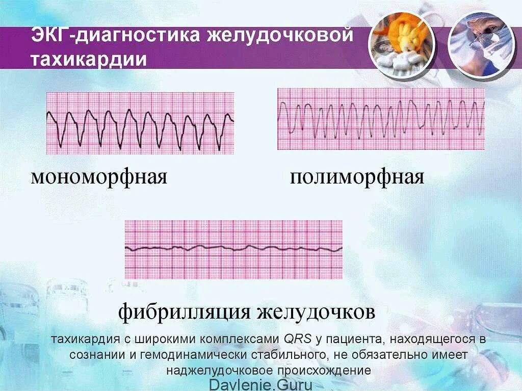 Желудочковая тахикардия на экг. Пароксизмальная мономорфная желудочковая тахикардия. Мономорфная желудочковая тахикардия ЭКГ. Пароксизмальная желудочковая тахикардия на ЭКГ. Пароксизмальная тахикардия желудочков ЭКГ.