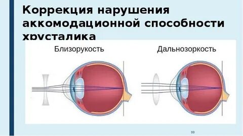 Миопия глазное яблоко