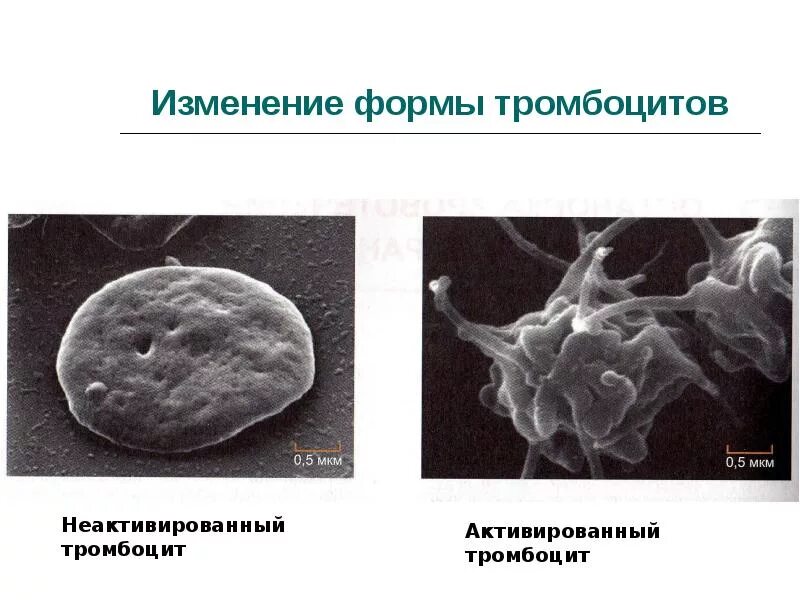 Изменения тромбоцитов. Изменения тромбоцитов