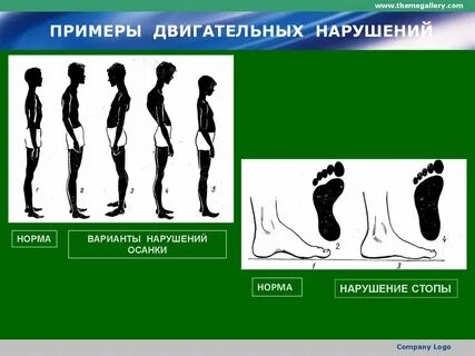 Формы двигательных нарушений