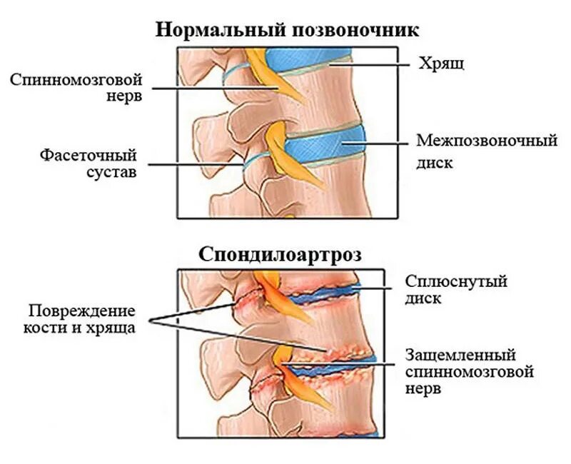 Суставы поясницы. Спондилоартроз пояснично-крестцового отдела позвоночника. Спондилоартроз l1-s1 пояснично-крестцового отдела позвоночника. Спондилоартроз поясничного отдела l1-s1. Спондилоартроз l2-s1 что это такое.