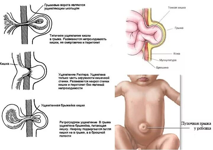 Ребенку 4 года болит пупок. Грыжа пупочная. Операция. Осложнения. Пупочная грыжа у новорожденного 1 месяц. Пупочная грыжа в 1,5 годика у ребенка.
