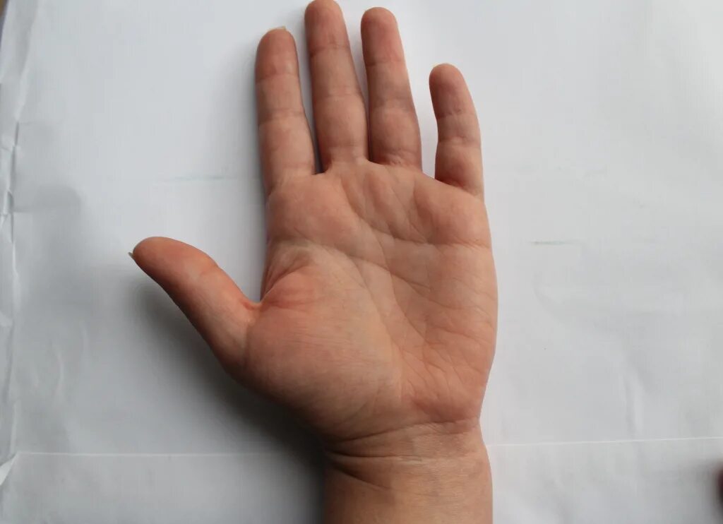 кисть руки. гигрома запястного сустава. внутренняя сторона указательного пальца. внутренняя сторона указательного пальца. гигрома межфалангового сустава.