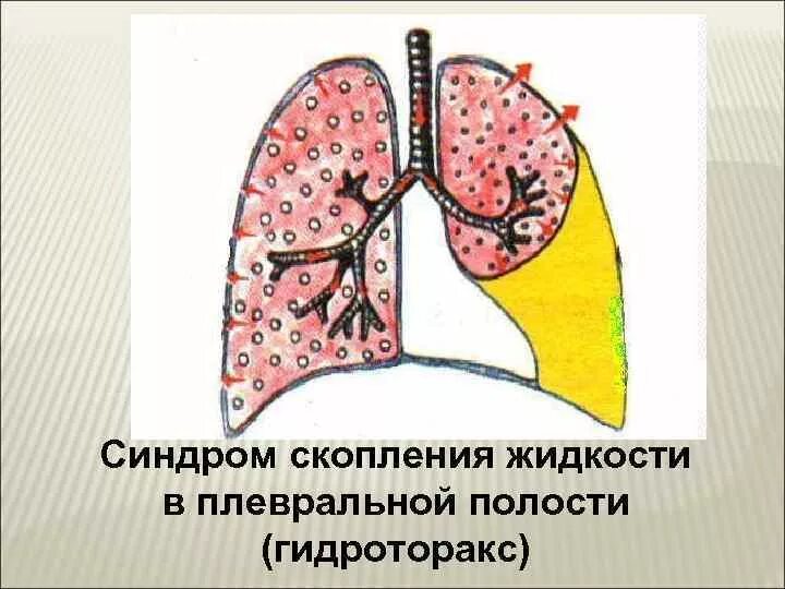 Может ли быть жидкость в легких