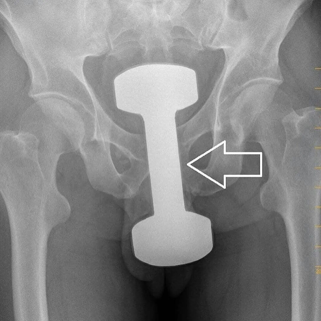 Предметы которые достали из прямой кишки. Инородные тела из прямой кишки. Инородные предметы в прямой кишке рентген. Предметы из прямой кишки. Инородные предметы в прямой кишке.