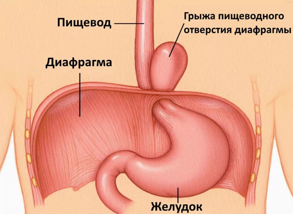 Грыжа под в желудке как лечить. Диафрагмальная грыжа пищеводного отверстия диафрагмы. аксиальная хиатальная грыжа. грыжа пищевод желудок диафрагмы. аксиальная грыжа пищеводного отверстия диафрагмы.