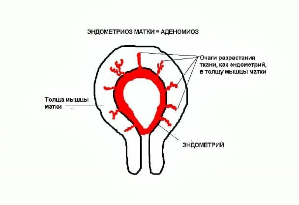 Диффузная форма матки. Эндометриоз аденомиоз матки.