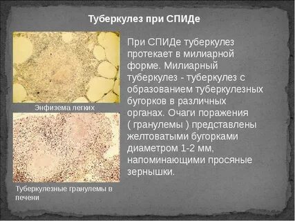 Туберкулез легких при вич