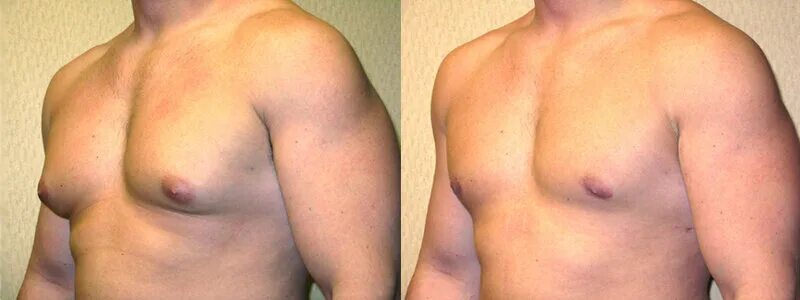 Гинекомастия липосакция. Липосакция мужской груди. Опухоль соска у мужчин. Опухоль соска у мужчин. Гинекомастия пролиферирующая.