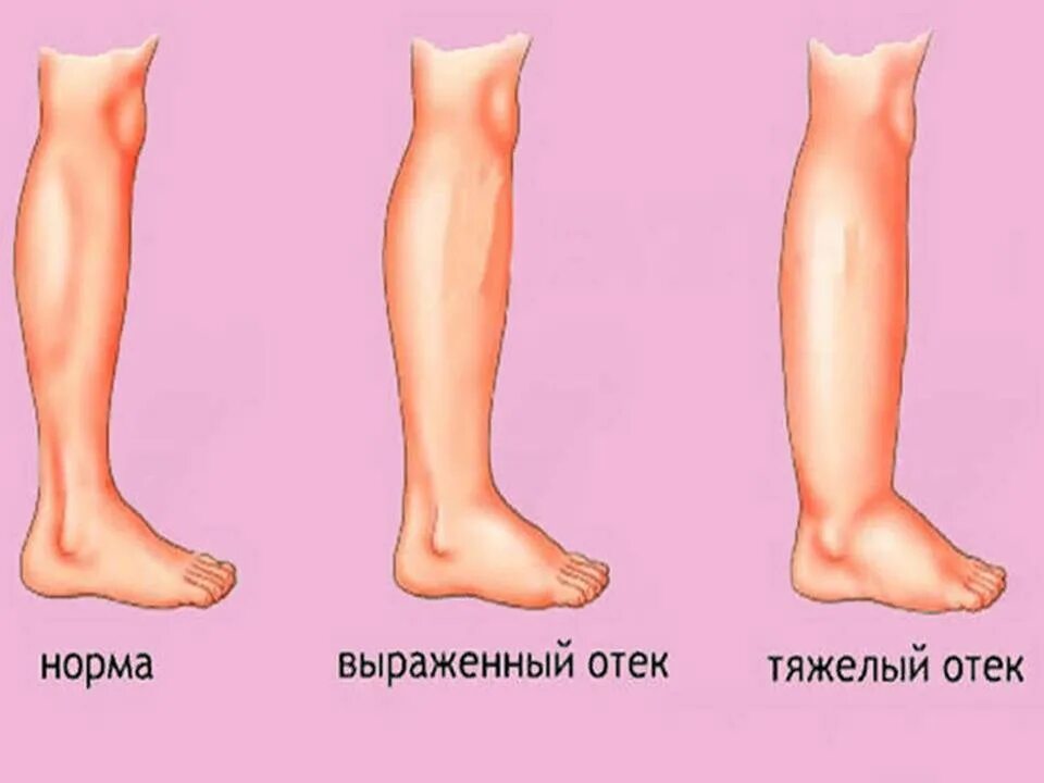 Как отличить отеки. Отёки при беременносии.