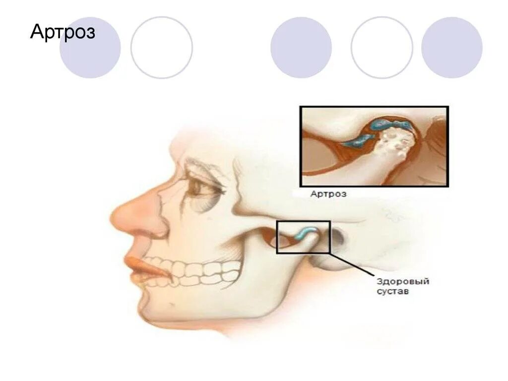 Лечение челюстного артрита. Остеоартроз ВНЧС рентген. Деформирующий остеоартроз ВНЧС. Левосторонний артрит ВНЧС. Деформирующий остеоартроз ВНЧС рентген.