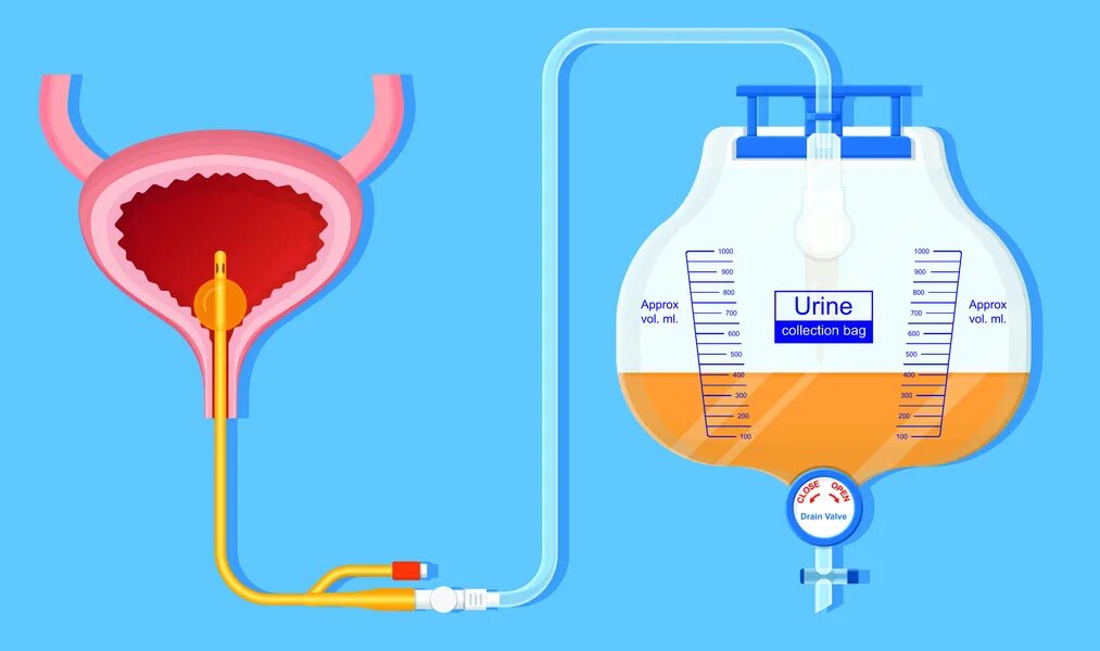 Катетер-ассоциированных инфекций мочевых путей. Катетер для мочеиспускания. При острой задержке мочи. Задержка мочеиспускания - ишурия. Подтеки мочи у мужчин