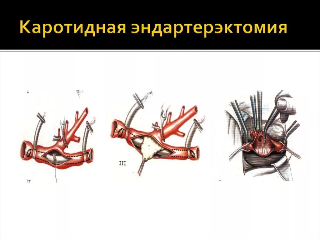 Эверсионная каротидная. Эндартерэктомия сонной артерии. Каротидная эндартерэктомия сонной артерии. Каротидная эндартерэктомия сонной артерии техника. Эндартерэктомия это