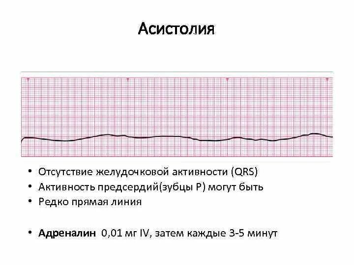 Асистолия что это. Асистолия предсердий на ЭКГ. Асистолия желудочков на ЭКГ. Асистолия ЭКГ критерии. Асистолия сердца на ЭКГ.