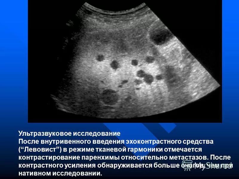 Киста селезенки лечение. Новообразование в печени на УЗИ. Множественные метастазы в печени УЗИ.