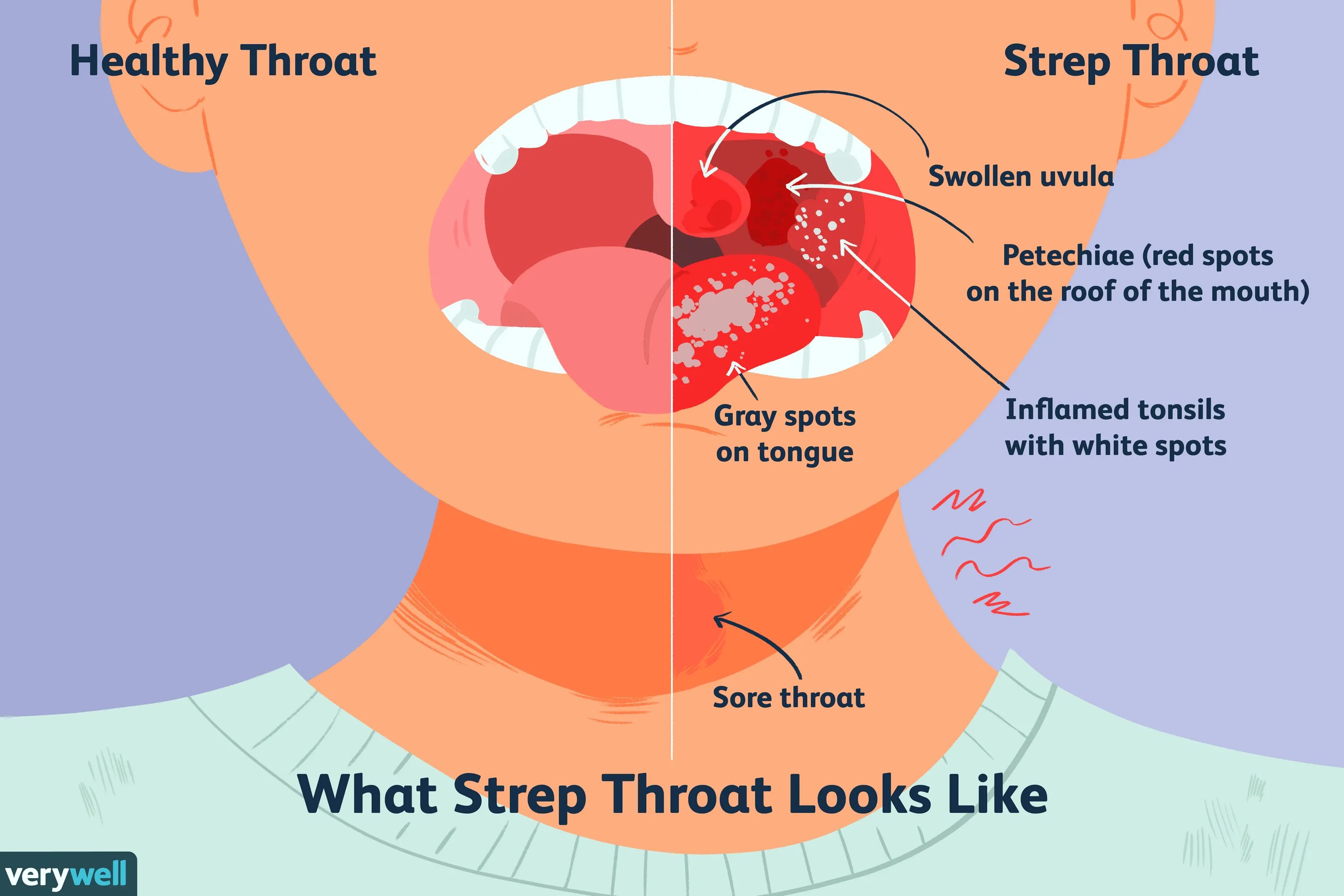 Bad throat. Стрептококковая инфекция в горле. Стрептококковая ангина. Горло при стрептококковой инфекции.