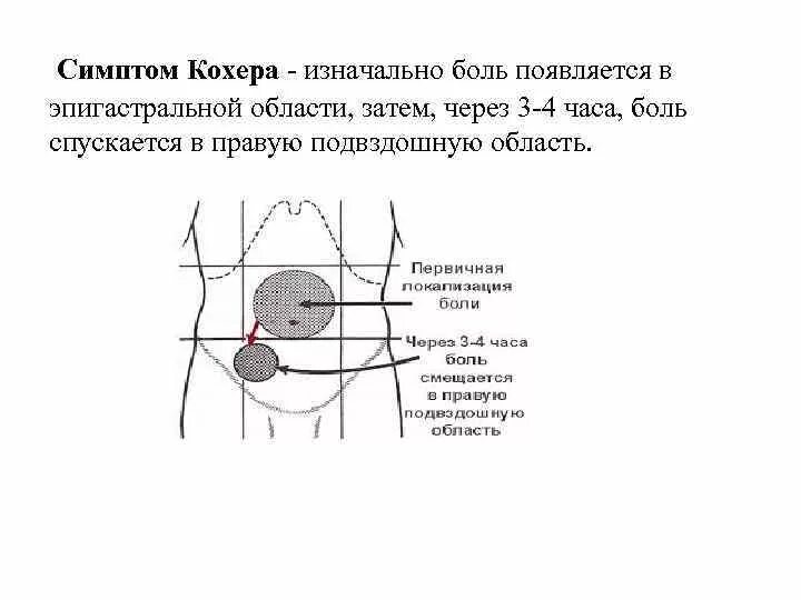 Боль в эпигастрии подвздошную область. Симптом кохера-Волковича. Острый аппендицит симптом кохера. Синдром кохера Волковича при аппендиците. Острого аппендицита - симптомы Волковича.