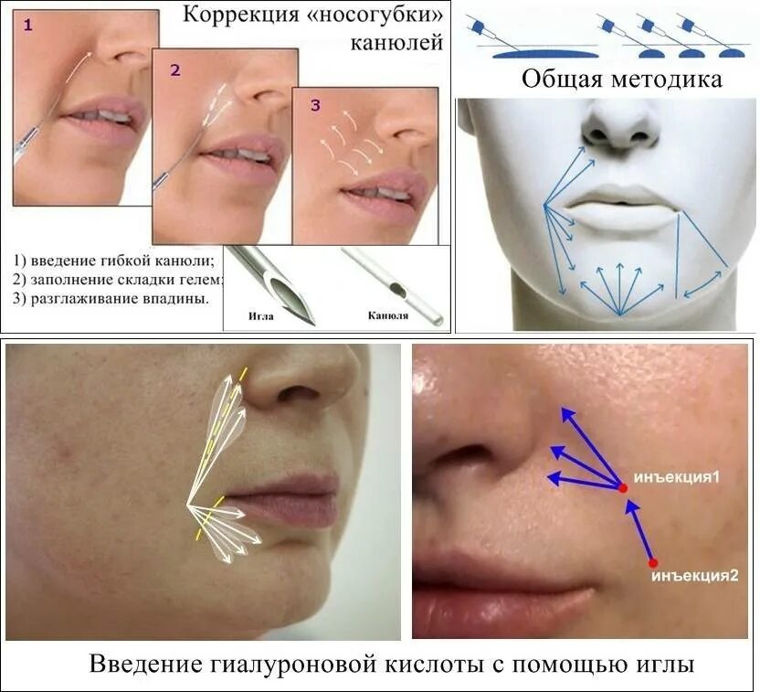 Введение филлеров в лицо