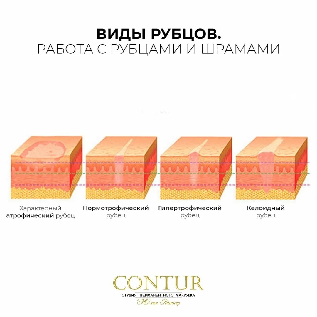 Образование шрамов