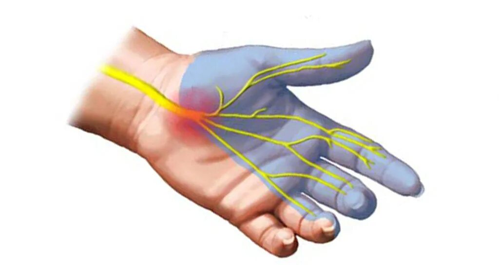 Туннельный синдром врачи. Синдром карпального канала кисти. Симптом запястного канала.