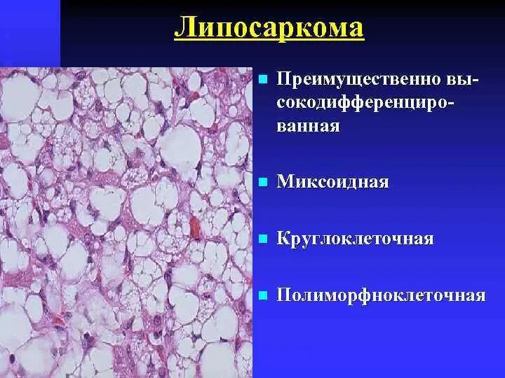 Круглоклеточная липосаркома. Высокодифференцированная липосаркома гистология. Круглоклеточная опухоль гистология. Злокачественная опухоль из соединительной