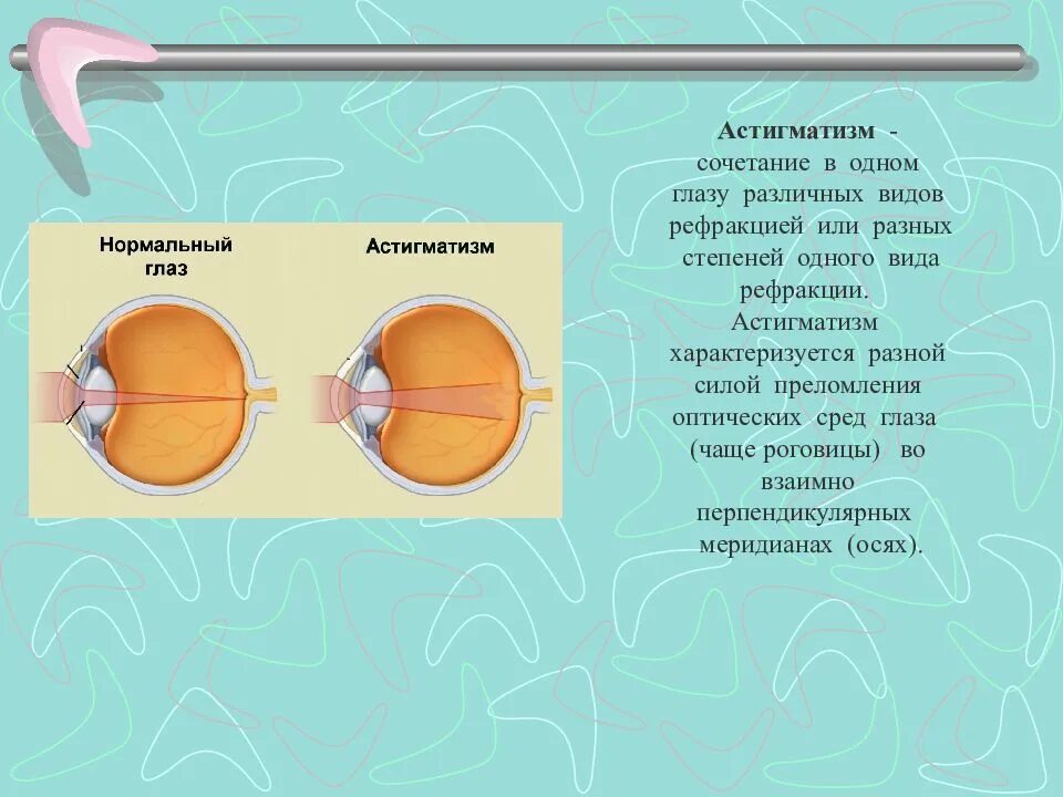 Преломляющие среды глаза. Рефракция глаза презентация. понятие о рефракции и аккомодации. рефракция и аккомодация. аккомодация зрения презентация.