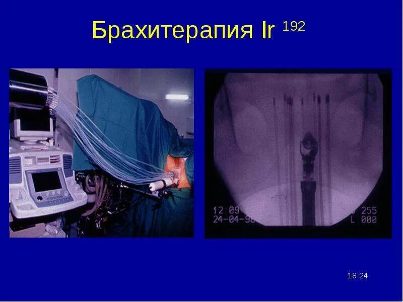 Низкодозная брахитерапия. Брахитерапия РШМ кобальт. Брахитерапия яичников. Брахитерапия молочной железы. Брахитерапия простаты цена