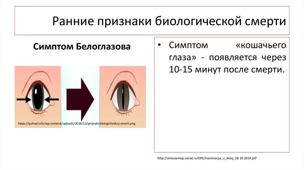 Признаки глазков. Признак Белоглазова кошачий зрачок. Кошачий глаз биологическая смерть. Ранее признаки биологической смерти. Кошачий глаз при биологической смерти человека.