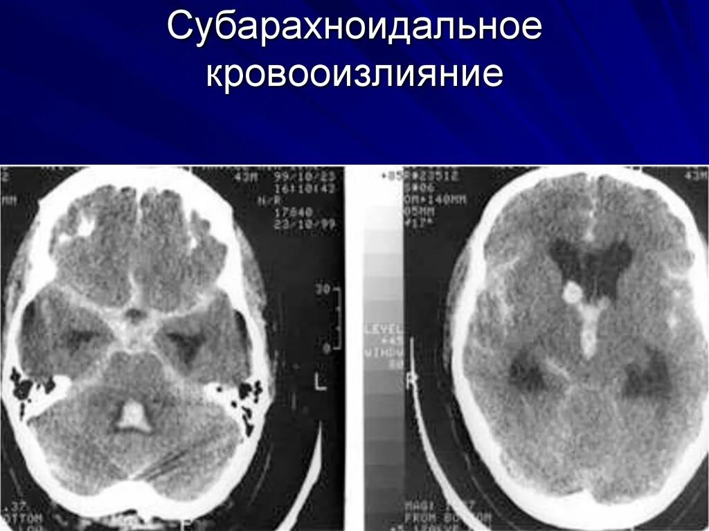 Умеренно расширение конвекситальных пространств. Субарахноидальные кисты. Субарахноидальное пространство мрт. Конвекситальные субарахноидальные пространства расширены. Расширение субарахноидального пространства кт.