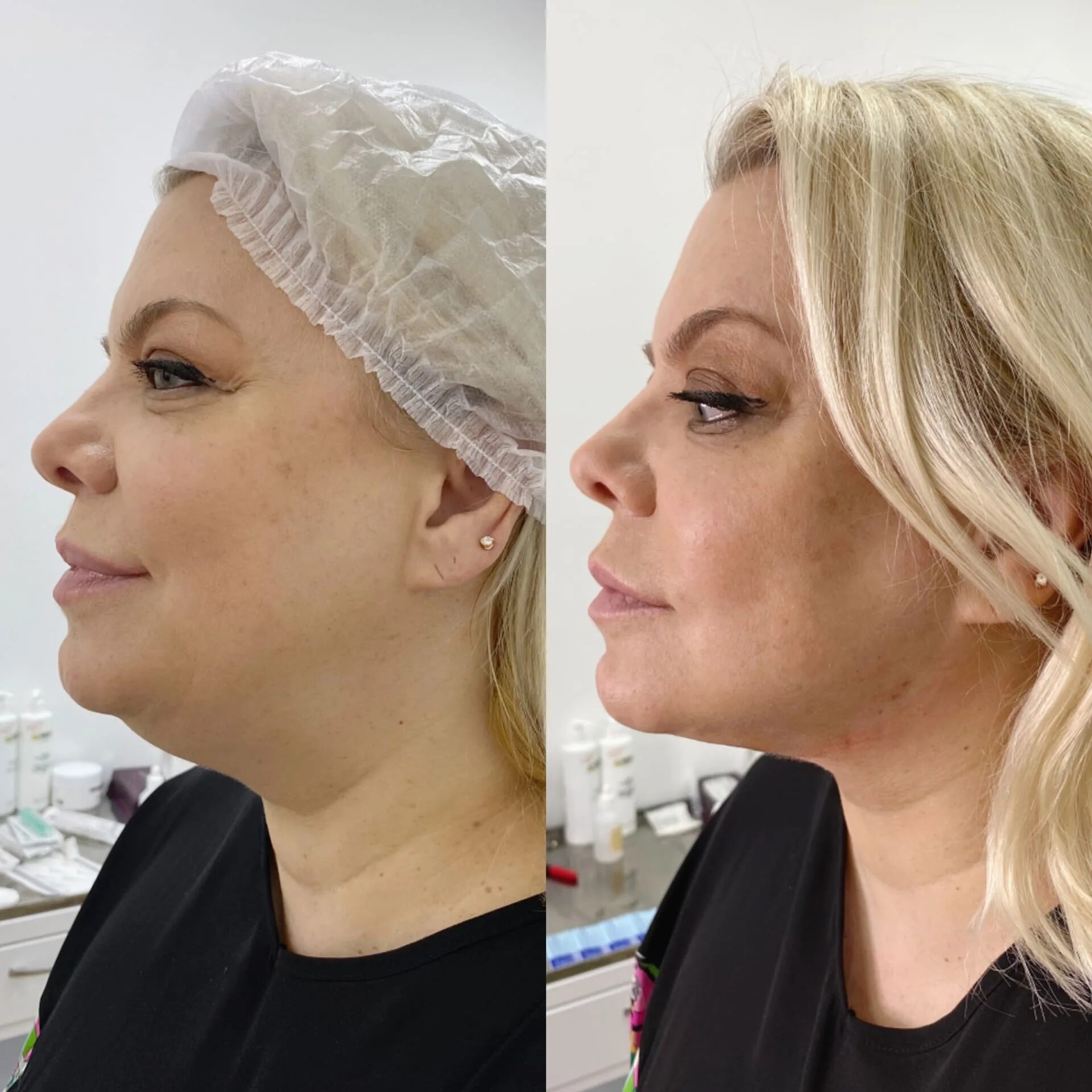 Нитевой лифтинг подбородка. Подтяжка подбородка. Нитевой лифтинг подбородка. Подбородок после нитей. Нити аптос в подбородок до и после.