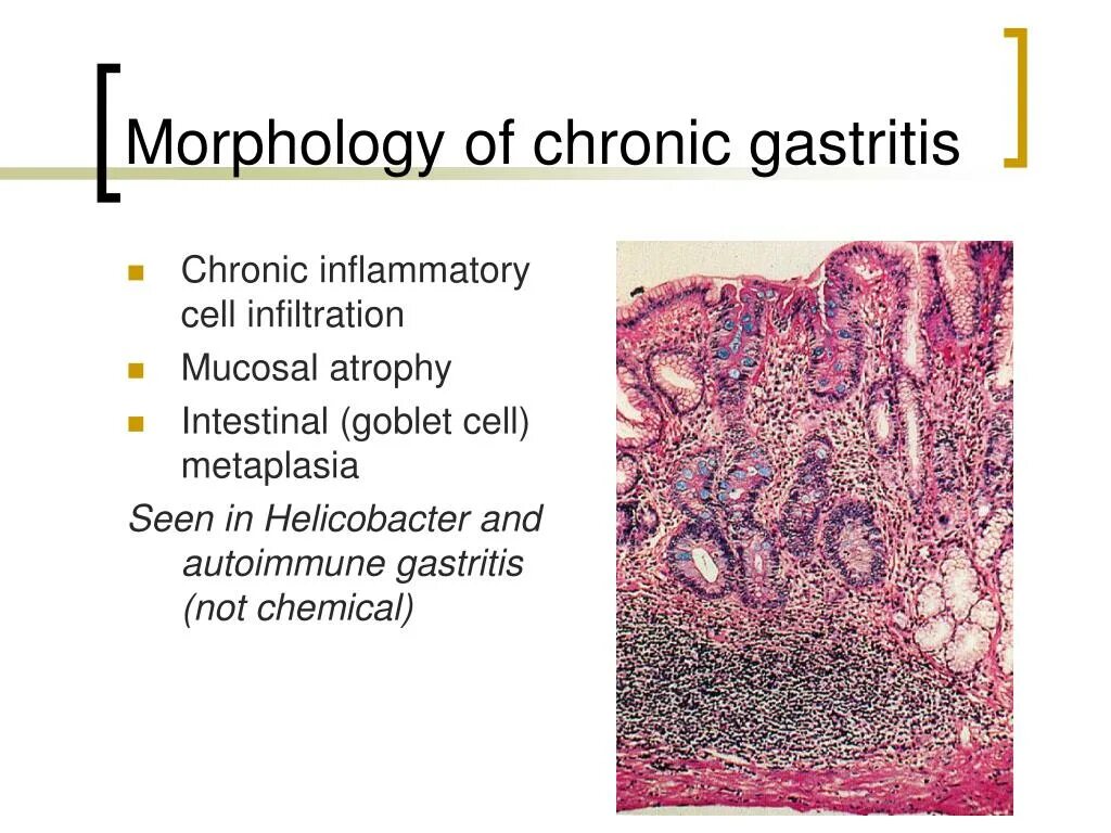 Атрофический латынь. Physical examination of chronic gastritis.