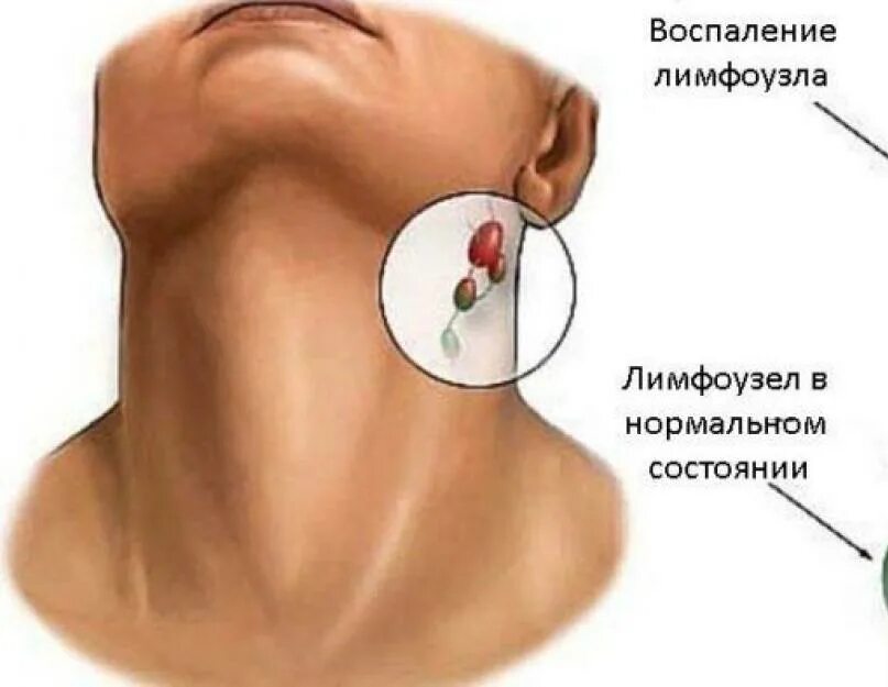 Тонзиллярные лимфоузлы. Воспалённые лимфоузлы. Воспаление лимфоузлов. Насморк и лимфоузлы