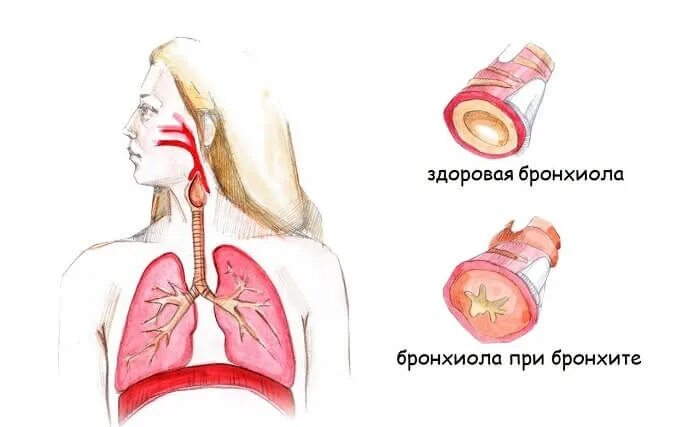 После операции болит легкое. Гнойные заболевания органов дыхания.