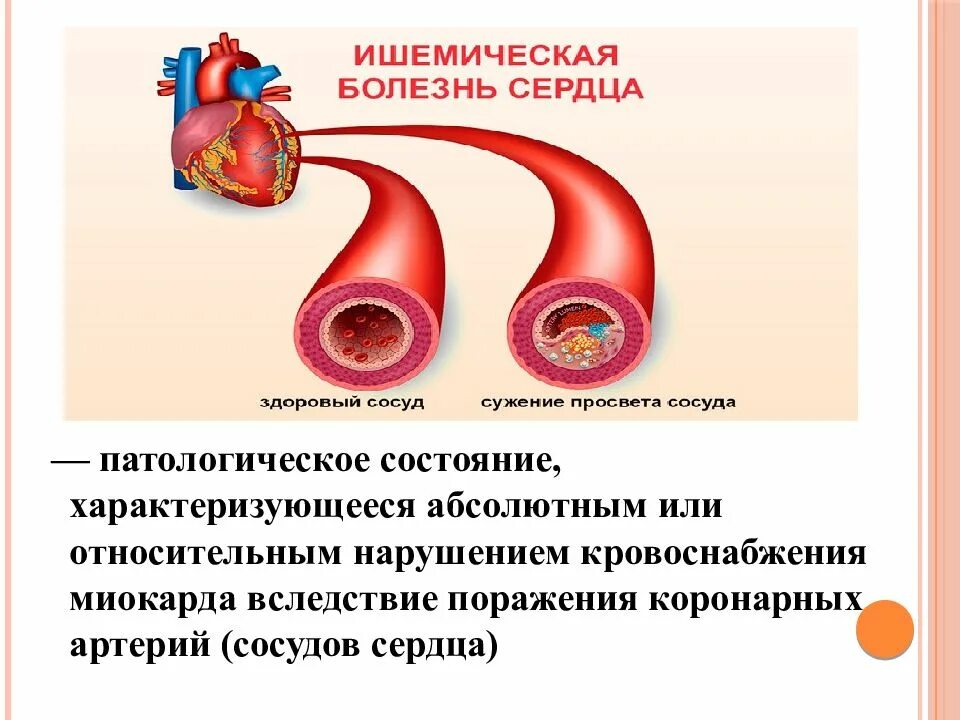 Признаки инфаркта у женщины 50 лет. Признаки инфаркта. Инфаркт симптомы. Признаки инфаркта миокарда. Приступ миокарда симптомы.