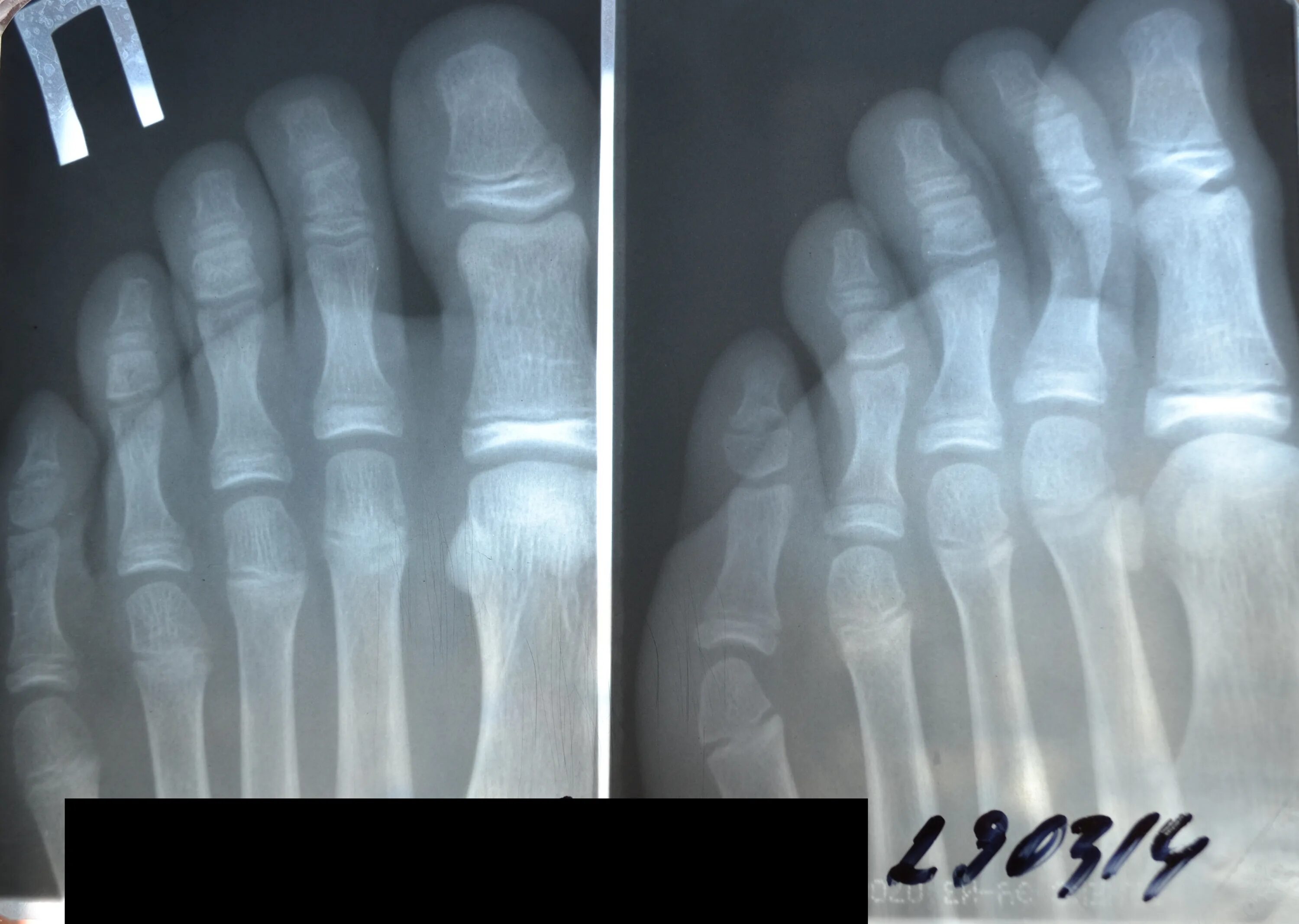 Рентген перелома дистальной фаланги 1 пальца. Перелом проксимальной фаланги 2 пальца. Закрытый перелом основной фаланги 1 пальца стопы рентген. Краевой перелом средней фаланги 5 пальца. Ногтевая фаланга ноги