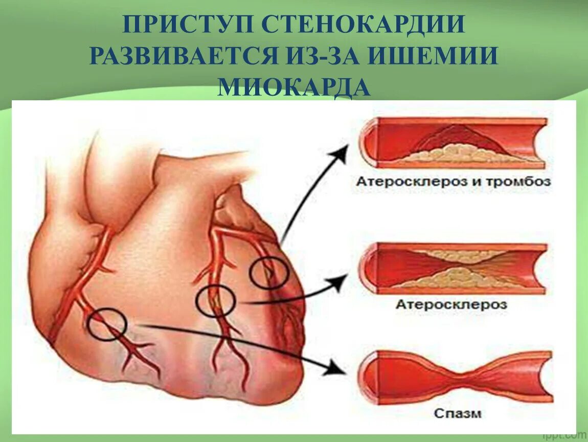 Ишемия сосудов симптомы. Атеросклероз, ИБС этиология. ИБС атеросклероз коронарных артерий. Мультифокальный атеросклероз. ИБС бессимптомная ишемия миокарда.