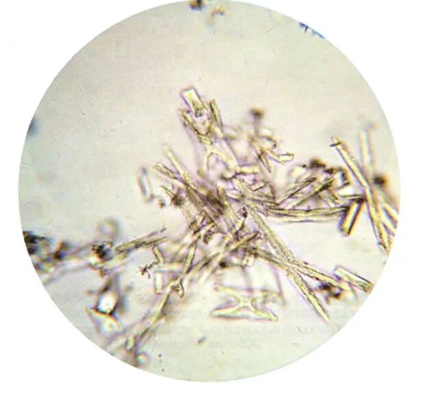 Фосфорнокислый кальций в моче микроскопия. Кристаллы фосфатов. Кристаллы аморфных фосфатов в моче. Кристаллы фосфатов. Оксалаты кальция в моче микроскопия.