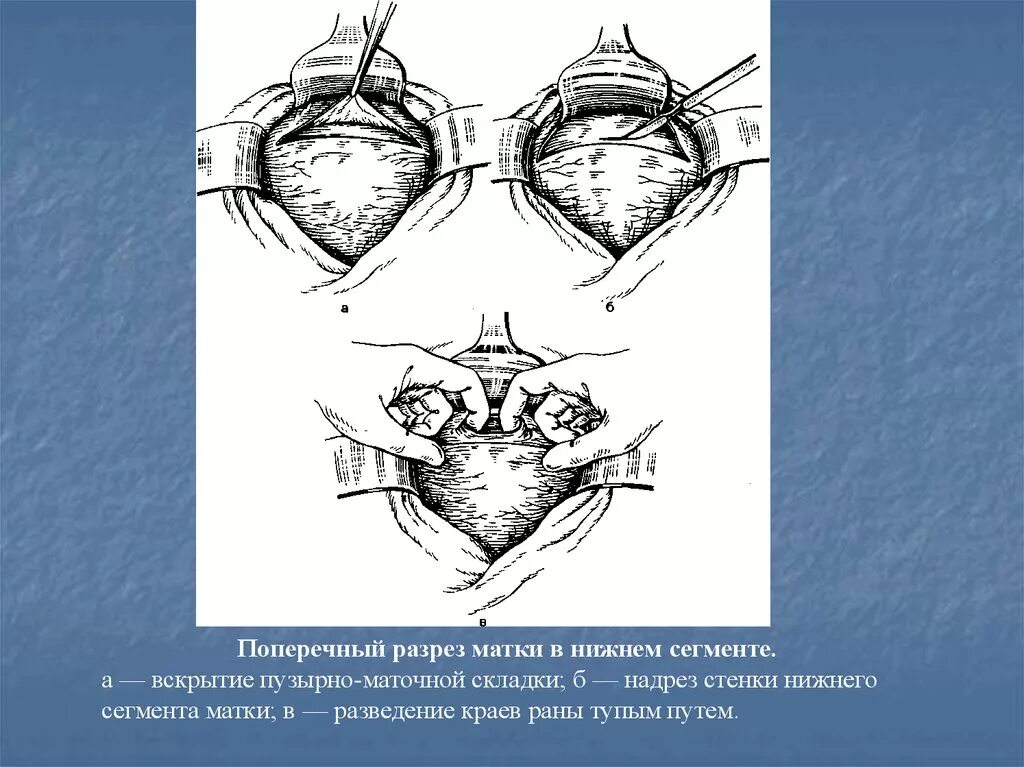 Сечение матки операция. Поперечный разрез Нижнего сегмента матки. Кесарево сечение в Нижнем маточном сегменте. Поперечный разрез маткматки. Вскрытие пузырно-маточной складки.