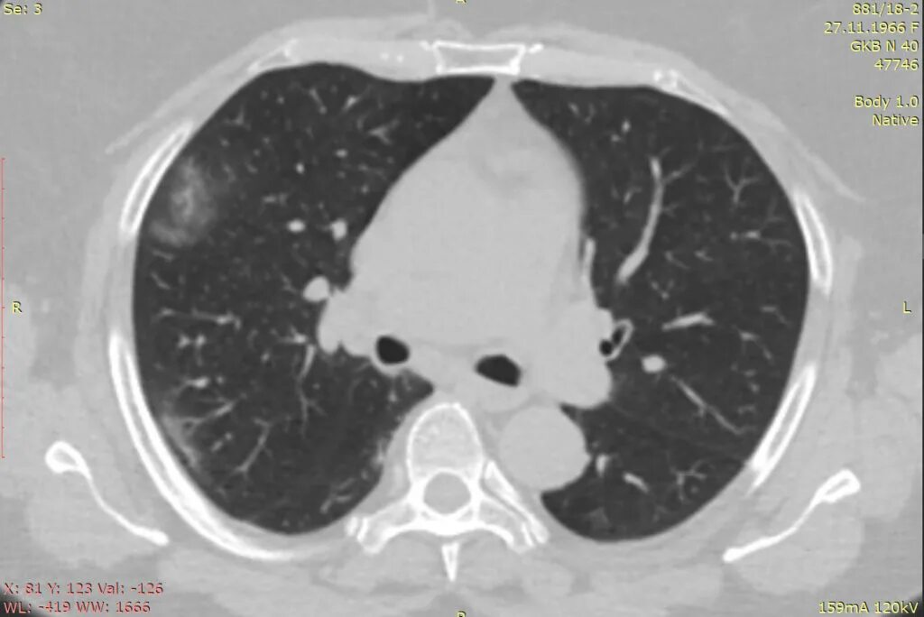 Поражение легких при ковиде. Карнификация легкого кт. Ковидная пневмония на кт. Вирусная пневмония ковид кт. Пневмония при коронавирусе на кт.