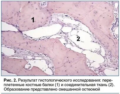 Костные балки