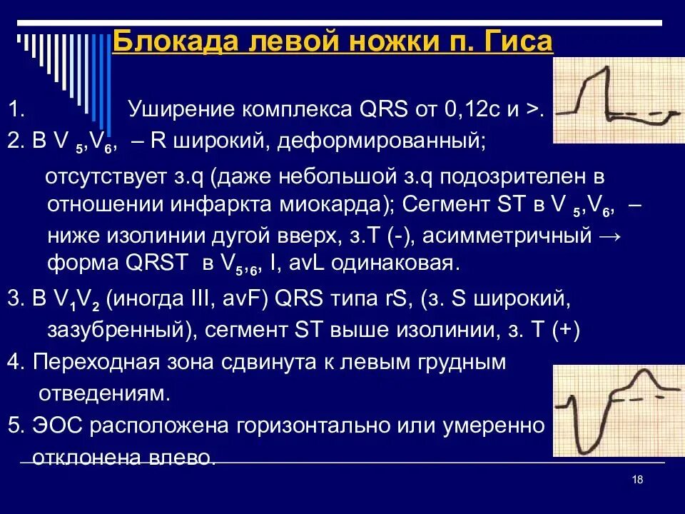 Блокада правого желудочка. ЭКГ при нарушении проводимости (блокады). Нарушения проводимости сердца блокады ЭКГ. ЭКГ критерии нарушения проводимости. ЭКГ признаки нарушения внутрижелудочковой проводимости.