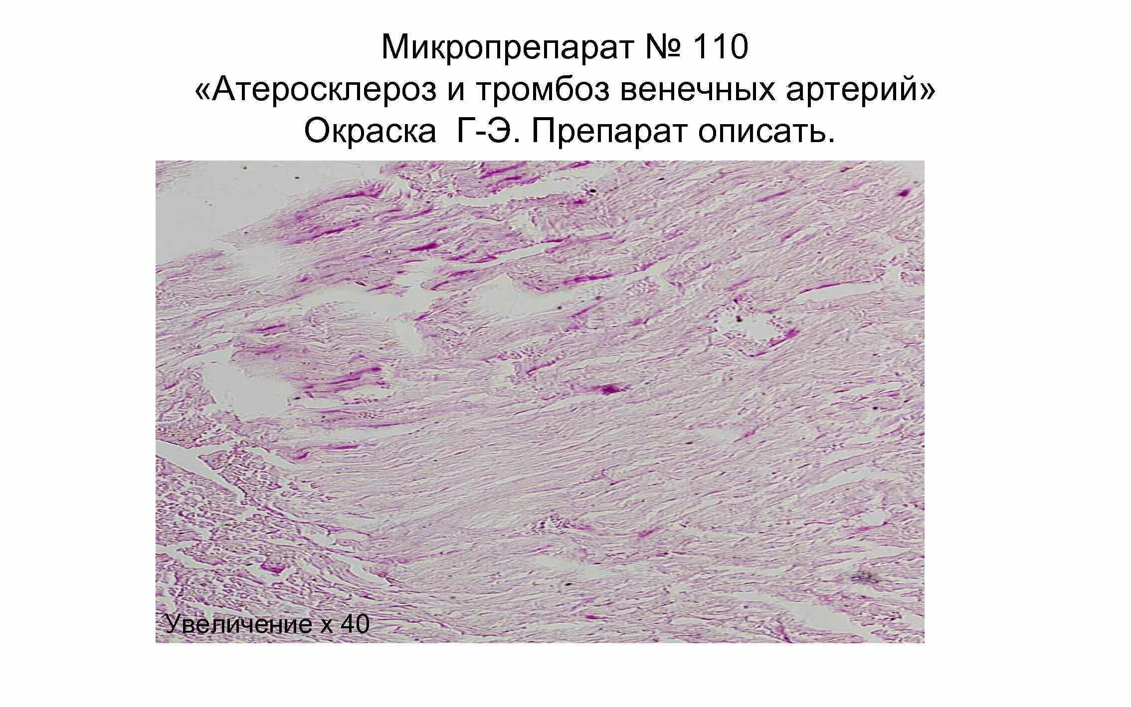 Тромбоз артерии гистология. Атеросклероз коронарной артерии микропрепарат. Атеросклероз венечной артерии патанатомия. Ишемическая болезнь сердца микропрепарат. Тромб микропрепарат