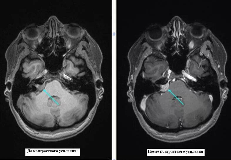 Шваннома мосто мозжечкового угла мрт. Арахноидальная киста мосто мозжечкового угла. Мосто-мозжечковый угол анатомия мрт. Невринома мосто-мозжечкового угла кт. Мозжечковая опухоль