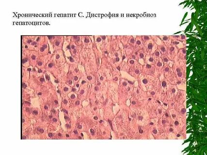 Хроническая дистрофия печени