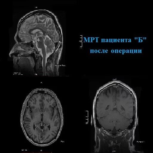 Менингиома лобной доли мрт. Петрокливальная менингиома. Ганглиоглиома головного мозга. Обызвествленная менингиома кт. Менингиома головы отзывы.