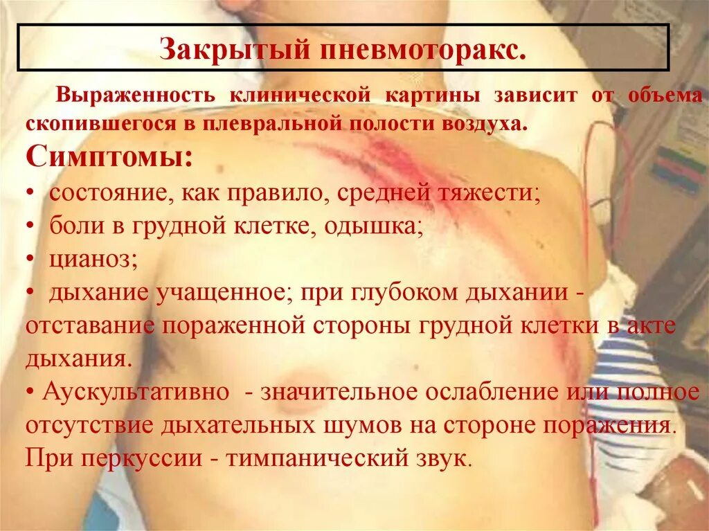 Помощь при открытом пневмотораксе тест. Симптомы при пневмотораксе. пневмоторакс клиническая картина.