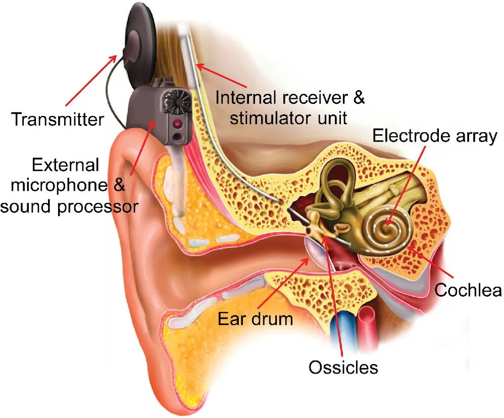 Слуховые стимулы. Кохлеарная имплантация Cochlear. Электродная решетка кохлеарного импланта. Кохлеарный имплант Кохлер. Интра кохлеарная имплантация.