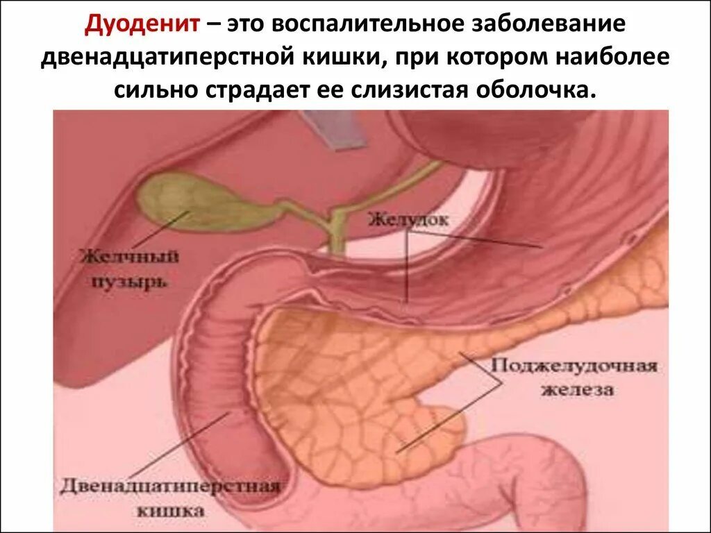 Двенадцатиперстная кишка дуоденит. Дуоденит и поджелудочная железа. Симптомы хронического дуоденита