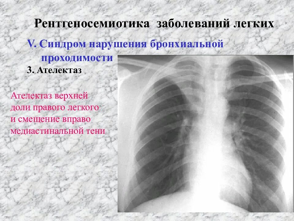 Признаки ателектаза легкого. Нарушение бронхиальной проходимости. Гиповентиляция легких рентген. Легкие нарушения бронхиальной проходимости что это такое. Гиповентиляция правого легкого.