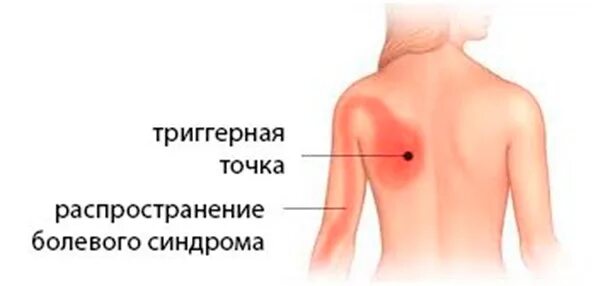 Болит правая лопатка и отдает в руку. Боль под лопаткой. Боль под левой лопаткой. Болит под лопаткой. Болит под левой лопаткой отдает в руку.